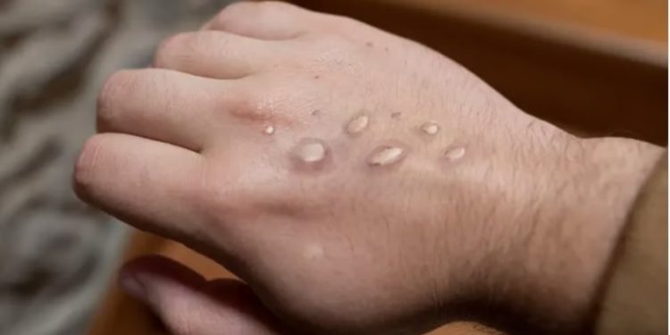 هل يسبب جدري القردة جائحة مثل كورونا؟.. مختص يوضح