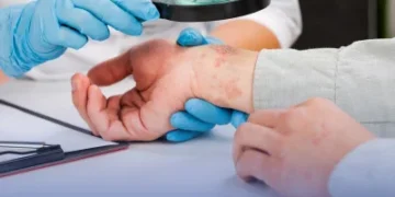 نصائح طبية لتخفيف أعراض “الإكزيما”