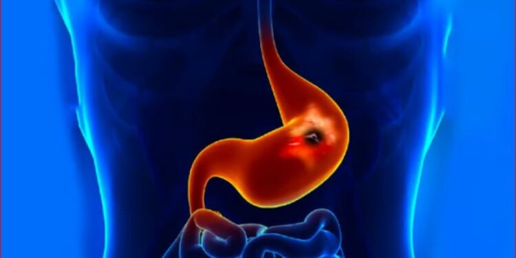 استشاري: إهمال علاج جرثومة المعدة قد يحولها إلى ورم سرطاني