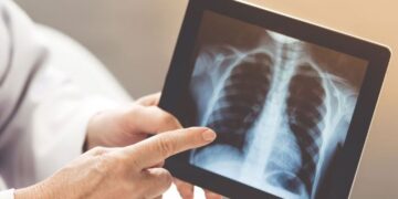 بالفيديو.. مختصة توضح أسباب أمراض التليف الرئوي وطرق الوقاية والعلاج