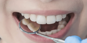 مختصة: 5 أسباب وراء تسوس الأسنان