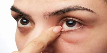 تظهر في العين.. تحذير من أكبر علامة على ارتفاع الكوليسترول في الدم