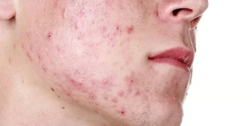 هل الشمس تشفي حب الشباب؟.. أخصائية توضح