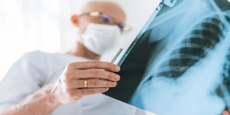 اكتشاف علاج جديد مبتكر لسرطان الرئة بنسبة نجاح تصل إلى 90%