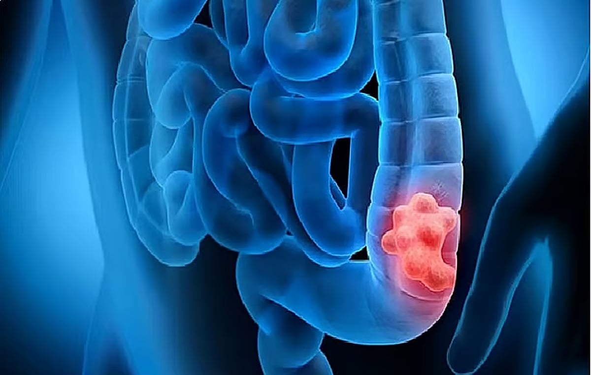 استشاري: القولون العصبي لا يحتاج التدخل الجراحي