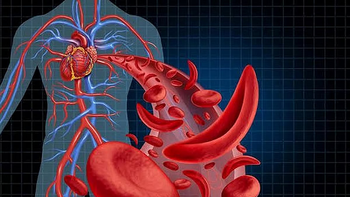 تجمع الرياض الصحي يوضح خطوات تساعد في التعايش مع الأنيميا المنجلية