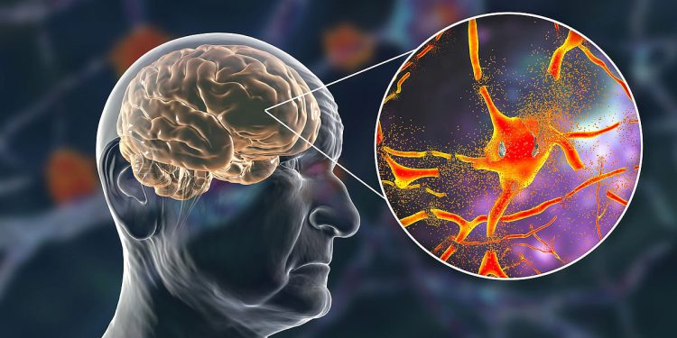 دراسة طبية تكشف عن مؤشر بيولوجي لتسارع شيخوخة الدماغ