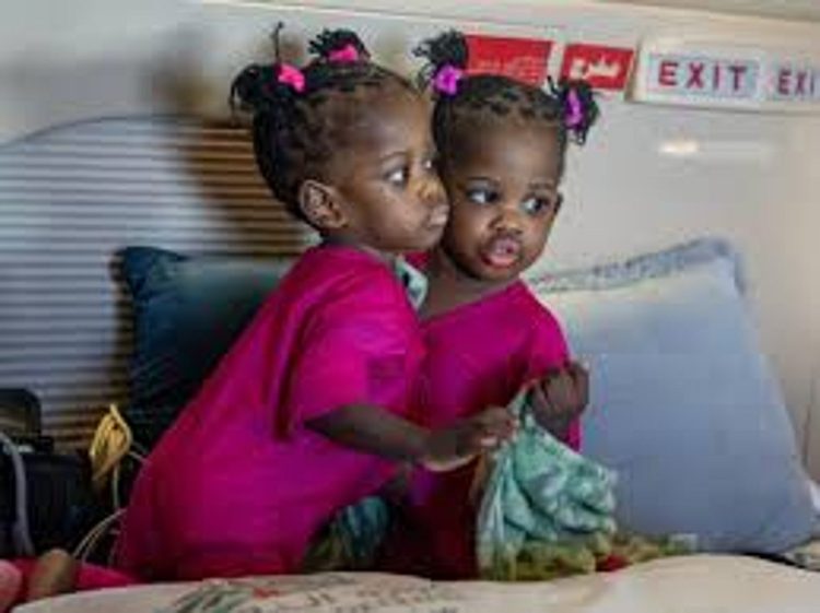 بعد مرور أسبوعين من عملية الفصل.. استقرار حالة التوأم الجامايكي "أزاريا" واستمرار "أزورا" بحالة حرجة 