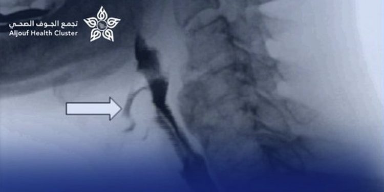 نجاح توسعة مريء لطفل بالمنظار دون تدخل جراحي في «تخصصي الجوف»