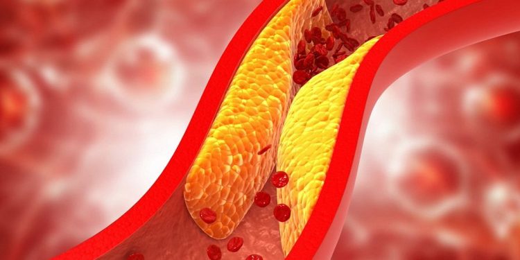 استشاري: علاج الكوليسترول المبكر أكثر فاعلية من تأخيره لما بعد الخمسين