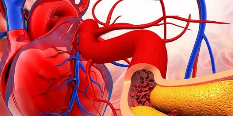 الخضيري يوضح أسباب تصلب الشرايين وطرق الوقاية