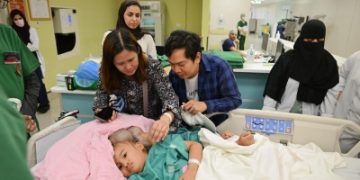 بدء فصل التوأم الملتصق الفلبيني 'كليا وموريس آن' في الرياض