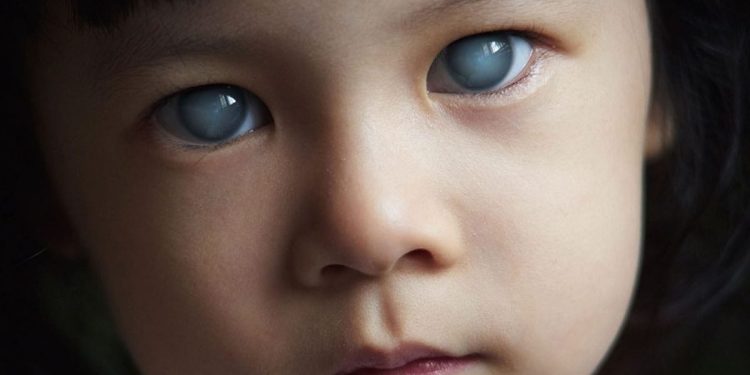 جلوكوما العين: كيف تحمي بصرك من “السارق الصامت” للبصر؟- الكحال