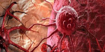 علماء روس يبتكرون تقنية حديثة لتدمير الخلايا السرطانية