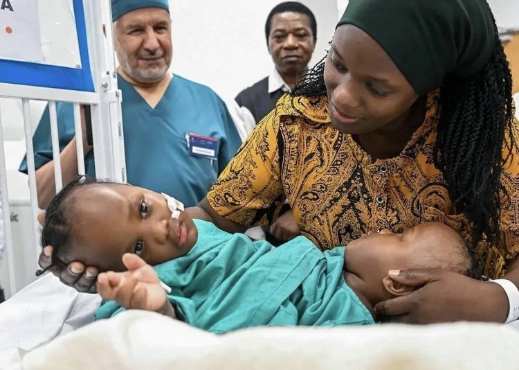 مقطع يوثق لحظة فصل التوأم التنزاني "نانسي ونايس" من داخل غرفة العمليات
