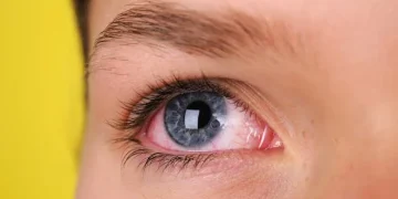 احمرار العينين صباحاً.. متى يكون طبيعياً ومتى يستدعي زيارة الطبيب؟