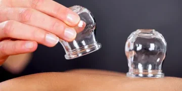 المركز الوطني للطب البديل: زيادة دم الحجامة لا ترفع فاعليتها العلاجية